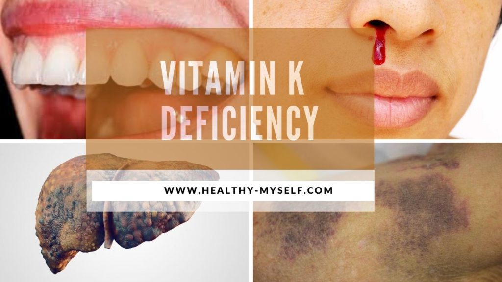 Vitamin k deficiency